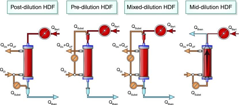 Schematische Darstellung der Hämodiafiltration zur Behandlung bislang unzureichend adressierter Probleme bei Nierenversagen
