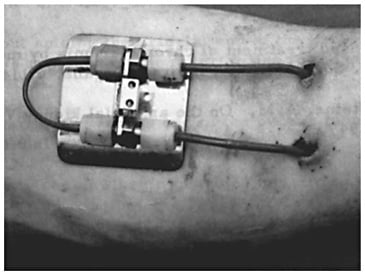 Historischer äußerer arteriovenöser Teflon-Shunt nach Quinton, Dillard und Scribner